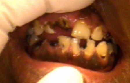 Before gum diseased
